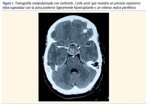 Figura 1. Tomografía computarizada con contraste. Corte axial que muestra un proceso expansivo
intra-supraselar con la zona posterior ligeramente hipercaptante y un intenso realce periférico.